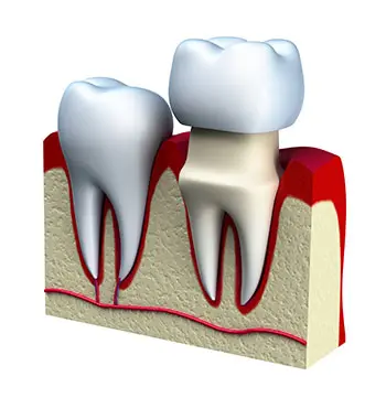 dental-crowns-richardson-texas