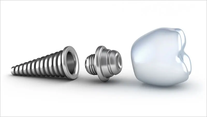 Dental Implant Parts | Richardson Family Dentistry | Richardson TX