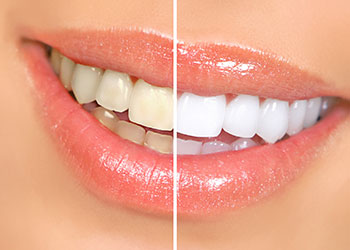 teeth-whitening-richardson-texas